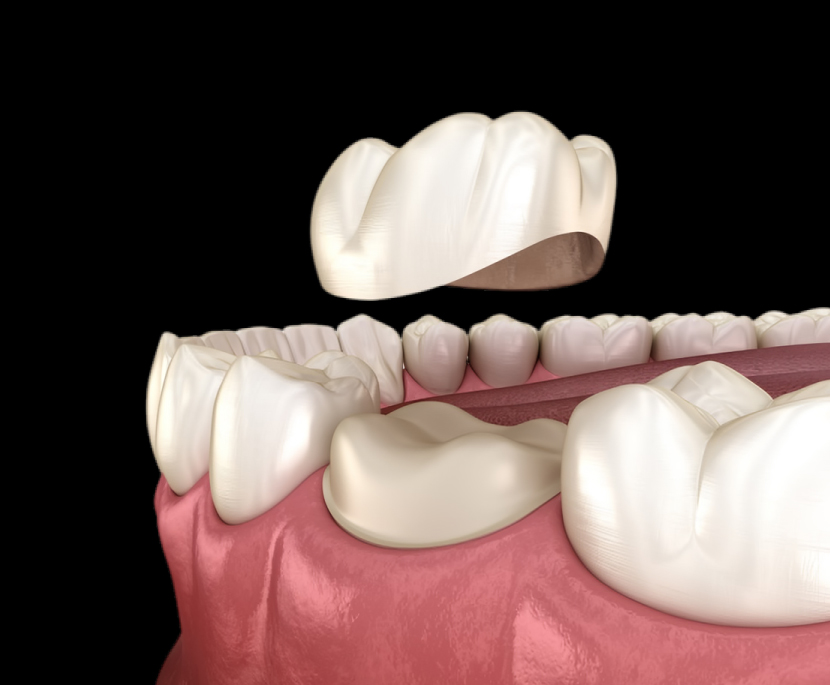 dental crown model