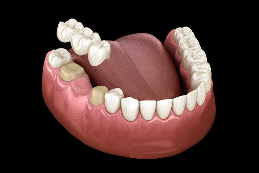 3D dental model showing complete denture with artificial teeth on pink gum base.