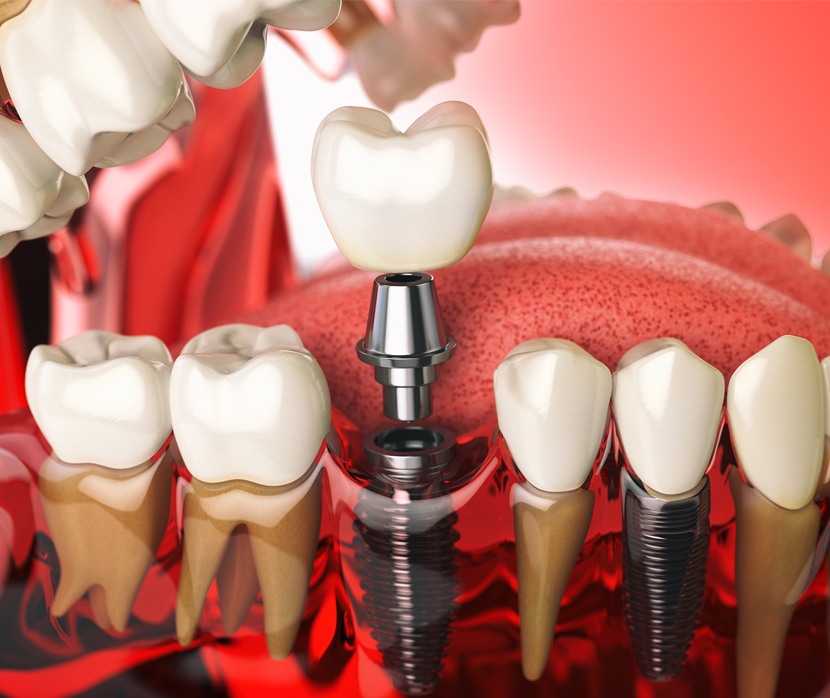 Dental Implants Reno
