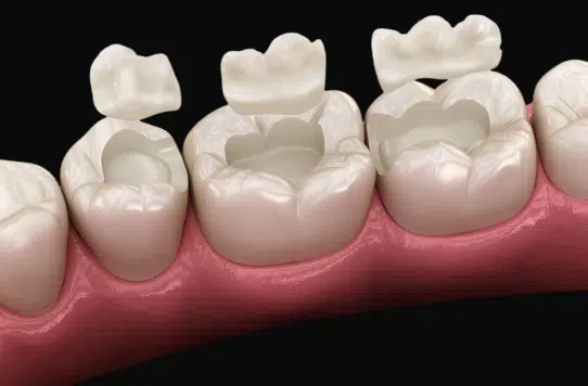 Digital dental restoration showing multiple tooth crowns on pink gum model.