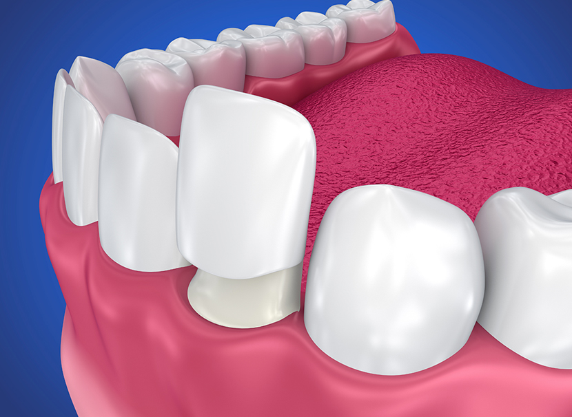 dental veneers