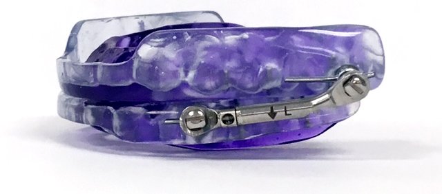 Purple transparent orthodontic appliance device showing internal mechanical components and gears.
