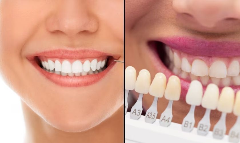 Veneers vs. Teeth Whitening