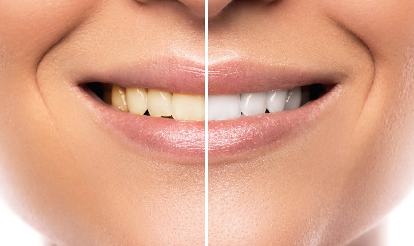 Teeth Whitening vs Teeth Cleaning